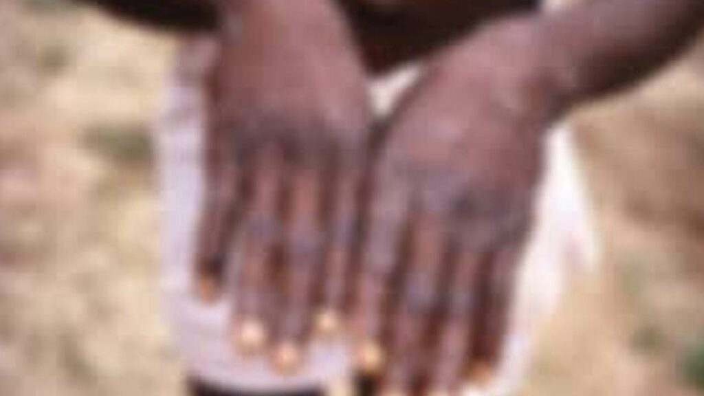 Monkeypox