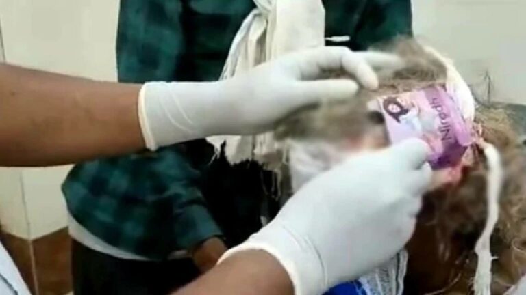 Madhya Pradesh: తల గాయానికి “కండోమ్ ప్యాక్” తో డ్రెస్సింగ్..