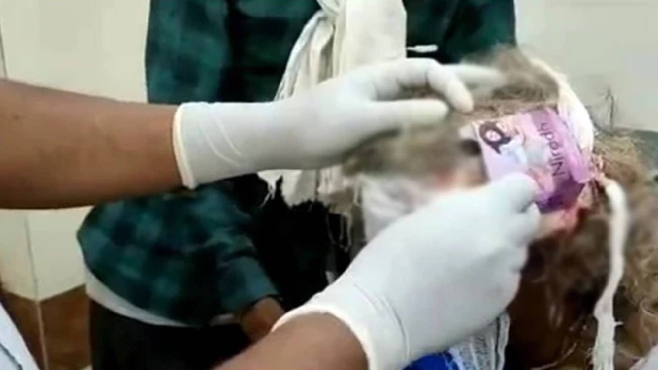 Madhya Pradesh: తల గాయానికి “కండోమ్ ప్యాక్” తో డ్రెస్సింగ్..