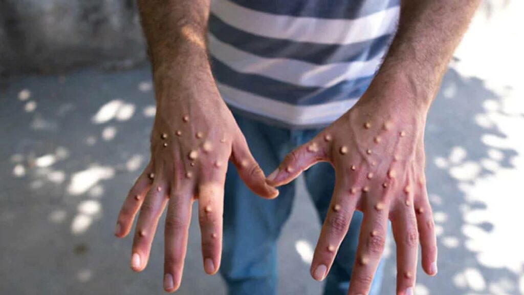 Monkeypox In Kerala