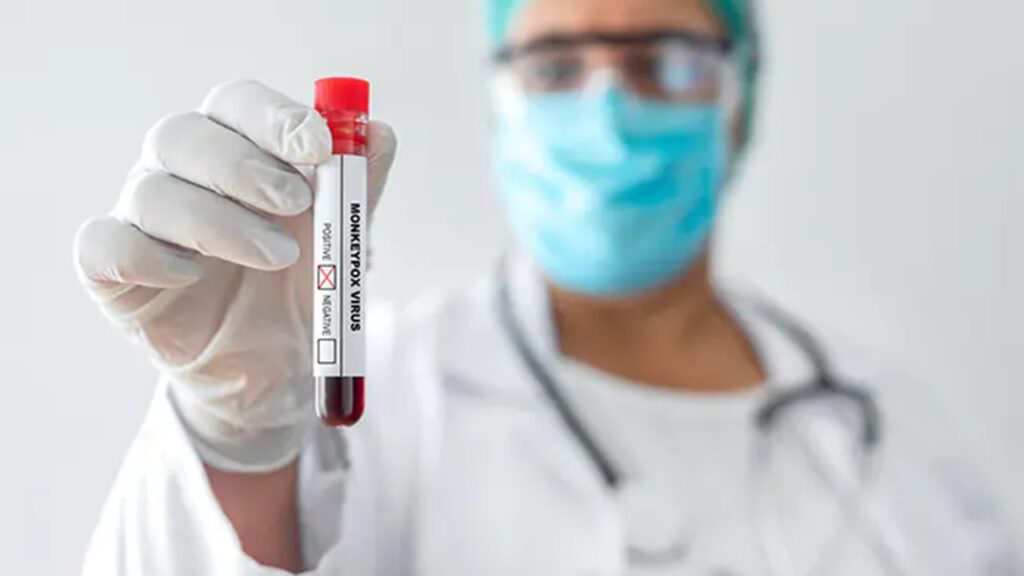 Monkeypox Virus