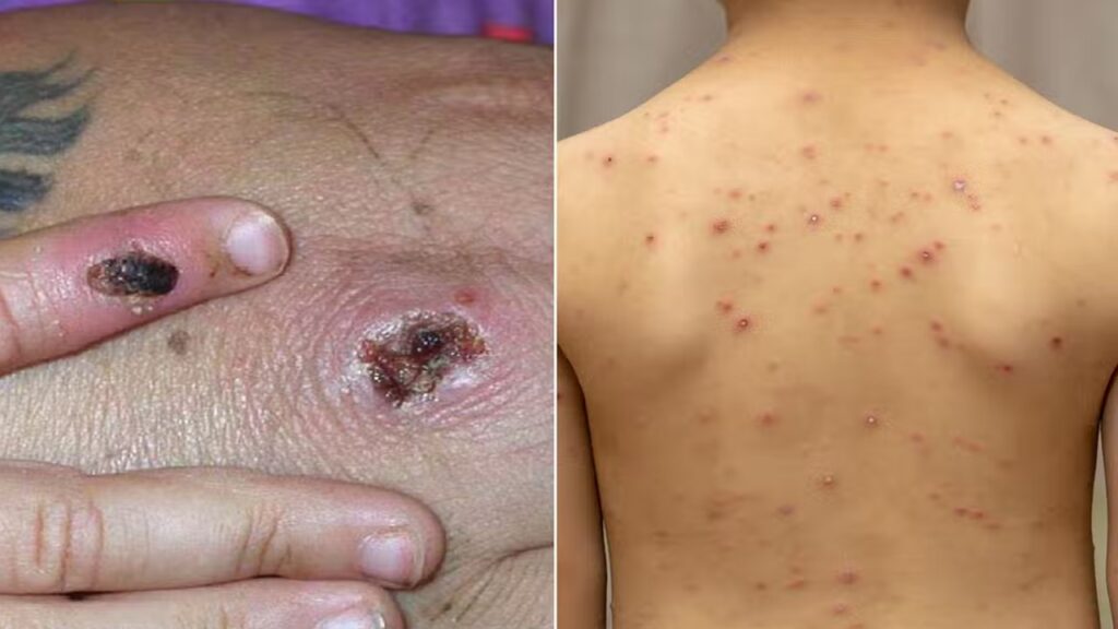 Monkeypox Vs Chickenpox