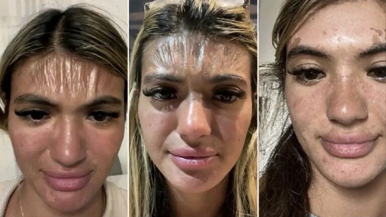 Skin Looking Like Plastic: ప్లాస్టిక్‌లా మారిపోయిన ఓ మహిళ చర్మం.. కారణమేమిటో తెలుసా?