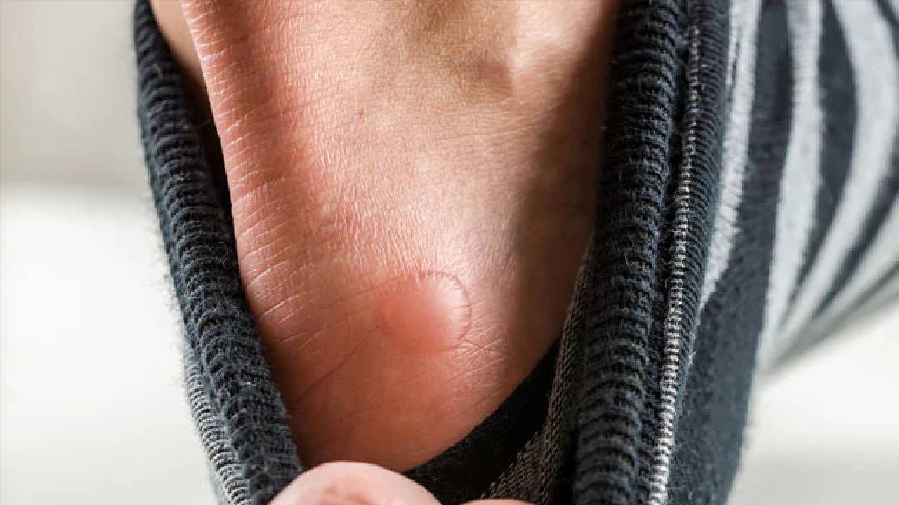 Tomato Flu: టొమాటో ఫ్లూ వ్యాధిపై రాష్ట్రాలకు సూచనలు చేసిన కేంద్రం