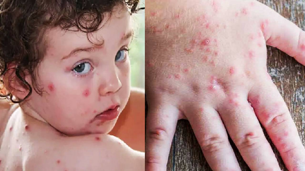 Tomato Flu: “టమోటో ఫ్లూ”పై భారత్ అప్రమత్తంగా ఉండాలి.. లాన్సెట్ హెచ్చరిక