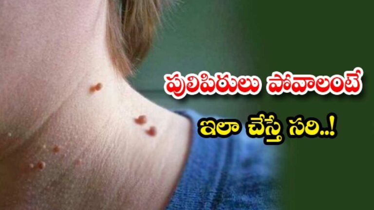 Health Tips : పులిపిర్లతో విసిగిపోయారా.. అయితే ఈ చిట్కాలుతో చెక్‌ పెట్టండి