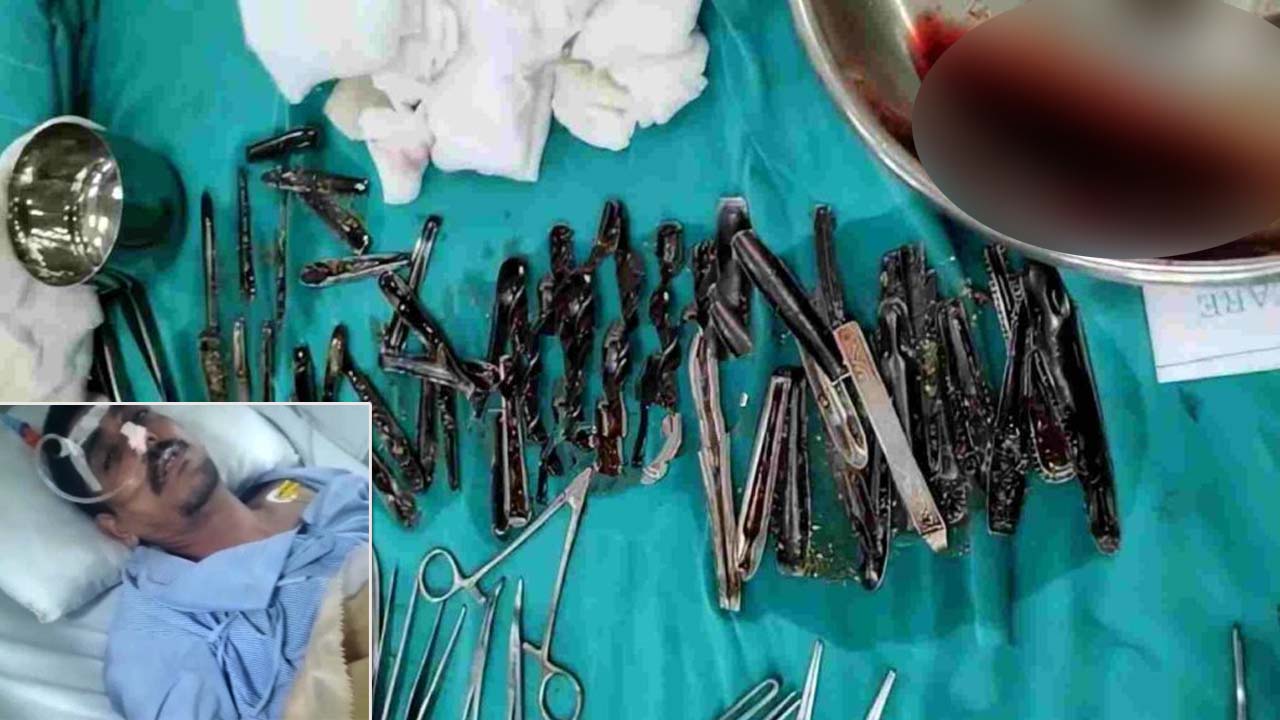 63 spoons in the stomach: ఆశ్చర్యకరమైన ఘటన.. కడుపులో ఏకంగా 63 స్పూన్లు