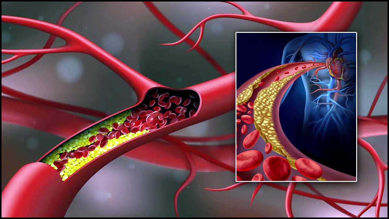 Cholesterol Levels: కొలెస్టిరాల్ పెరగడానికి.. ఈ సహజ తప్పులే కారణం