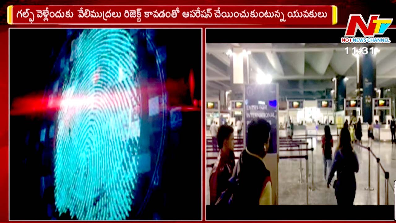 Fingerprint surgery: కొత్త తరహా మోసం.. గల్ఫ్ దేశాలకు వెళ్లేందుకు వేలిముద్రల సర్జరీ..