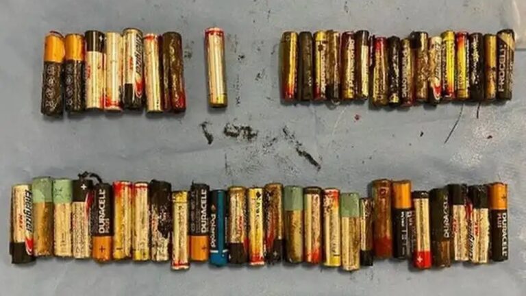 Ireland Old Woman: 55 బ్యాటరీలను మింగి.. డాక్టర్లకే చెమటలు పట్టించిన 66 ఏళ్ల వృద్ధురాలు