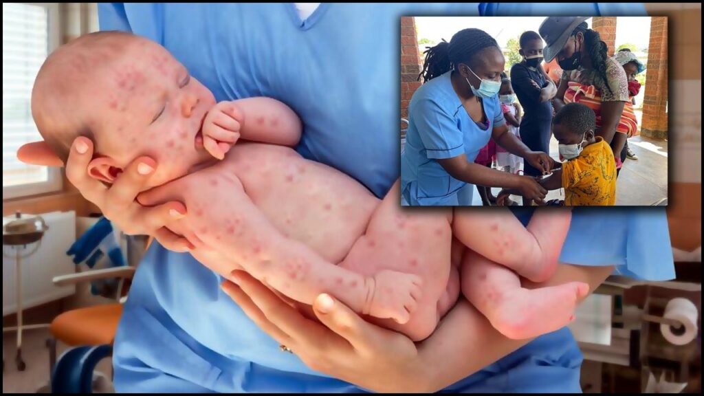 Measles Outbreakzimbabwe