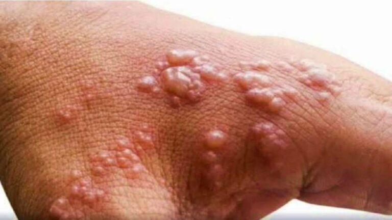 Monkeypox: ఢిల్లీలో మరో మంకీపాక్స్ కేసు.. దేశంలో మొత్తం కేసులు ఎన్నంటే..