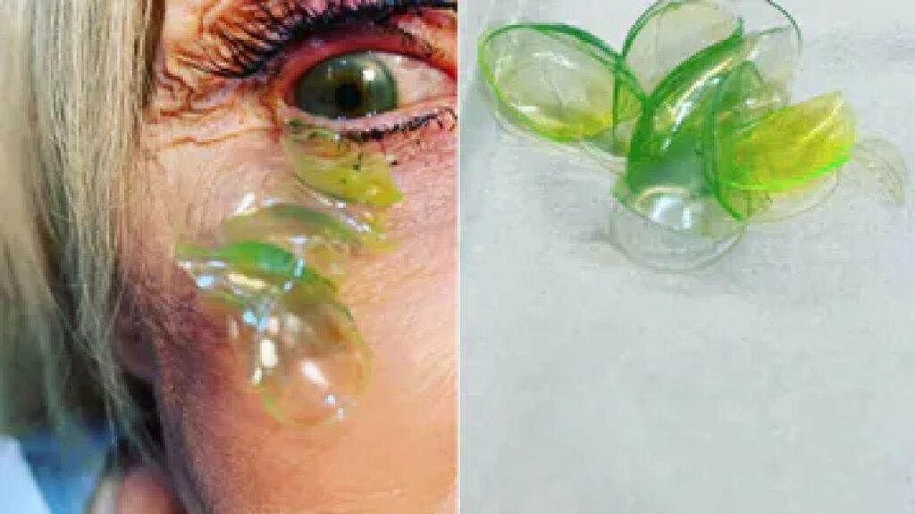 Contact Lens