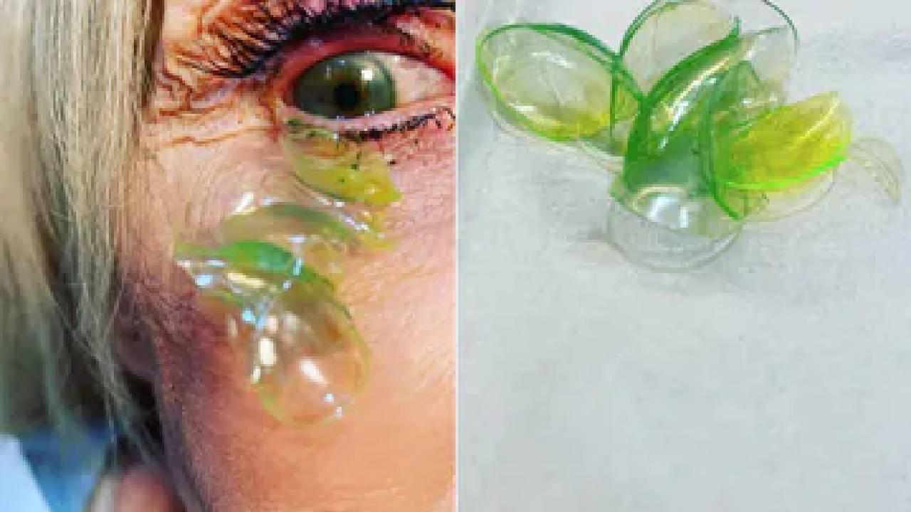 Contact Lense: వామ్మో.. కంట్లో ఇన్ని కాంటాక్ట్ లెన్సా ?.. షాక్ తిన్న డాక్టర్