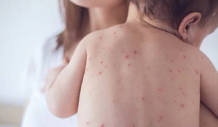 Measles