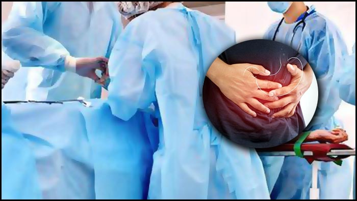 Operation Gone Wrong: డాక్టర్ నిర్వాకం.. గ్యాస్ట్రిక్ ప్రాబ్లమ్‌తో వచ్చిన వ్యక్తికి ఆపరేషన్ చేసి..