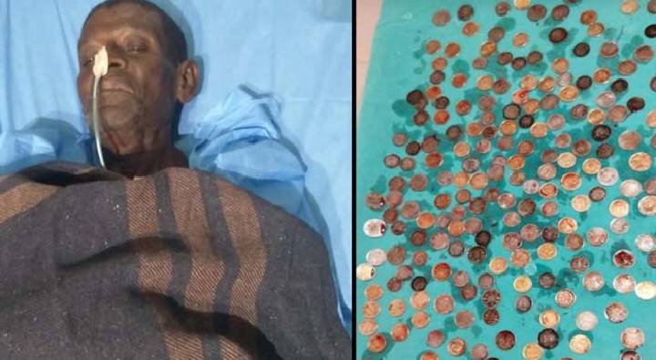 Coins In Stomach:  ఆపరేషన్ చేసిన డాక్టర్లే షాక్.. కడుపా లేదా కిడ్డీ బ్యాంకా ?