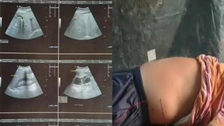 Uttar Pradesh: కిడ్నీలో రాళ్లు ఉన్నాయని వెళ్తే..  కిడ్నీనే మాయం చేశారు