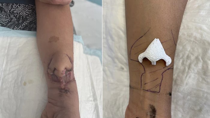 Transplant Nose: గ్రేట్‌.. చేతిపై ముక్కును పెంచి ముఖానికి అతికించారు!