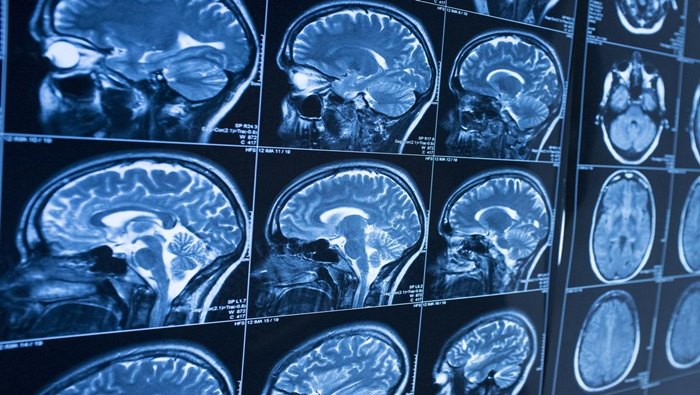 Alzheimers Disease: 19 ఏళ్లకే అల్జీమర్స్ వ్యాధి.. చైనా యువకుడిలో గుర్తింపు