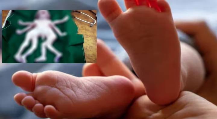 Strange Baby : రెండు గుండెలు, నాలుగు కాళ్లతో వింత శిశువు జననం