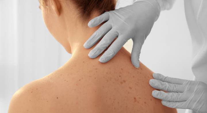 Skin Cancer : చర్మంపై ఎర్రటి మచ్చలు కనిపిస్తున్నాయా.. క్యాన్సర్ కావొచ్చు ?