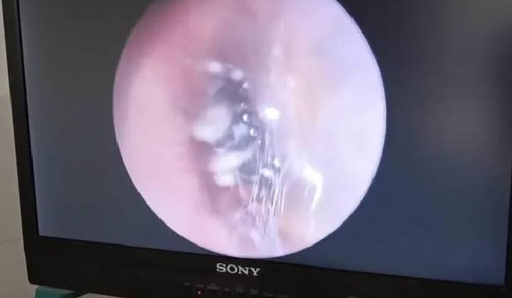 Spider Nest Inside Ear