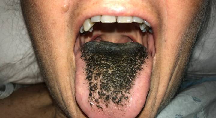 Hairy Tongue : మహిళకు అక్కడ కూడా వెంట్రుకలు… భయం లేదంటున్న డాక్టర్లు