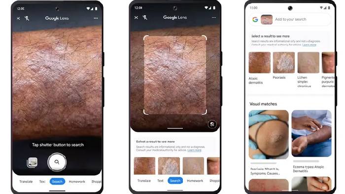 Google Lens: ఒక్క క్లిక్ చాలు.. గూగుల్ లెన్స్ మీ చర్మ సమస్యలను గుర్తిస్తుంది..