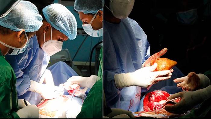 Largest Kidney Stone: కిడ్నీలో రాయి కాదు పెద్ద బండ.. గిన్నిస్ వరల్డ్ రికార్డ్ క్రియేట్