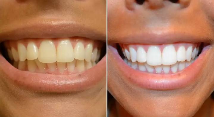 Teeth Naturally