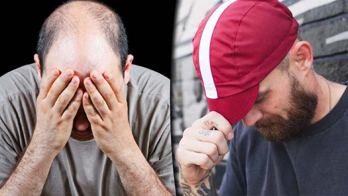 Hair Loss: క్యాప్ వాడితే జుట్టు రాలిపోయి బట్టతల వచ్చేస్తుందా?