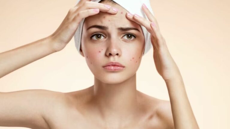 Homemade Pimples Face Packs: మొటిమల సమస్యతో ఇబ్బంది పడుతున్నారా?.. ఈ ఫేస్ ప్యాక్‌ని అప్లై చేస్తే అందమైన ముఖం మీ సొంతం!