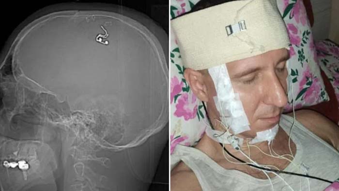 Viral News: డ్రిల్ మెషిన్‌తో తలకు రంధ్రం.. మెదడుకు శస్త్రచికిత్స..!