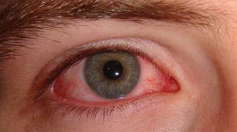 Conjunctivitis cases: దేశంలో పెరుగుతున్న కండ్లకలక కేసులు.. లక్షణాలు ఏంటంటే?