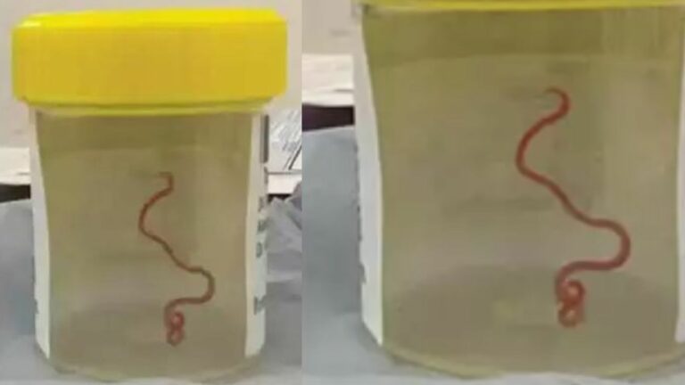 Worm in Brain: షాకింగ్‌ న్యూస్.. మహిళ మెదడులో 8 సెంటీమీటర్ల పురుగు! కొండచిలువలో ఉండే