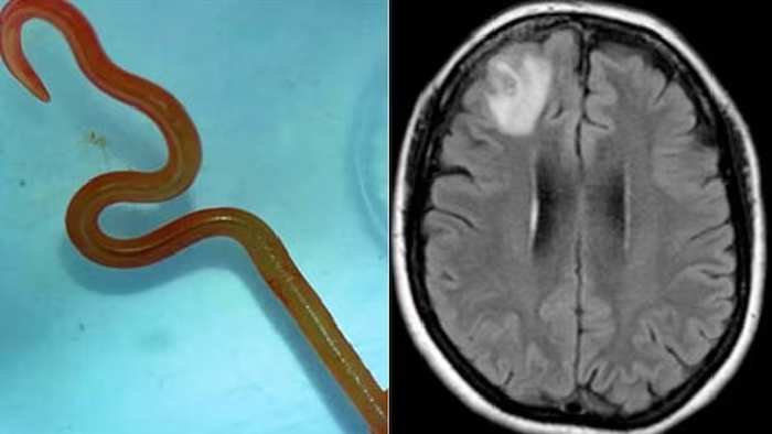 Worm in Woman’s Brain: మహిళ మెదడులో పరాన్నజీవి.. ప్రపంచంలో తొలి కేసు