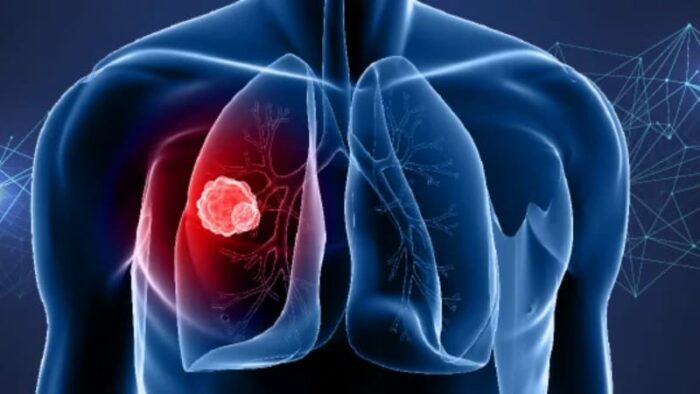 World Lung Cancer Day: ఊపిరితిత్తుల క్యాన్సర్ కు కారణాలు.. లక్షణాలు ఏంటో తెలుసా?