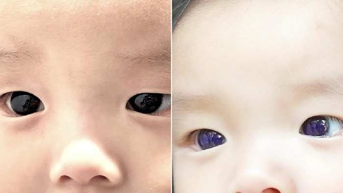 COVID-19: కోవిడ్ చికిత్స తరువాత చిన్నారి కళ్ల రంగు మారింది..