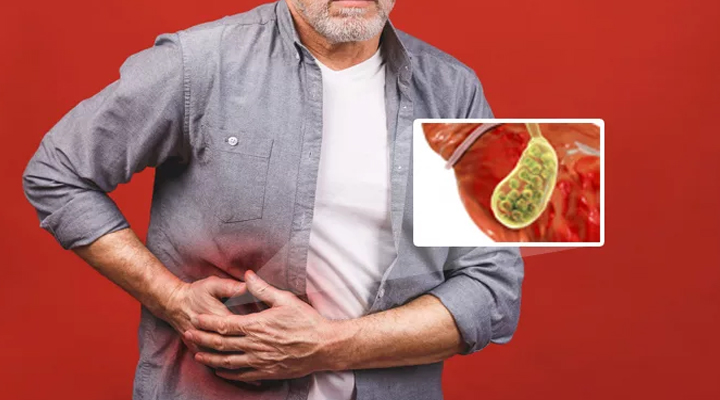 పిత్తాశయంలో 1,364 రాళ్లు.. 48 గంటలు కష్టపడి తొలగించిన వైద్యులు