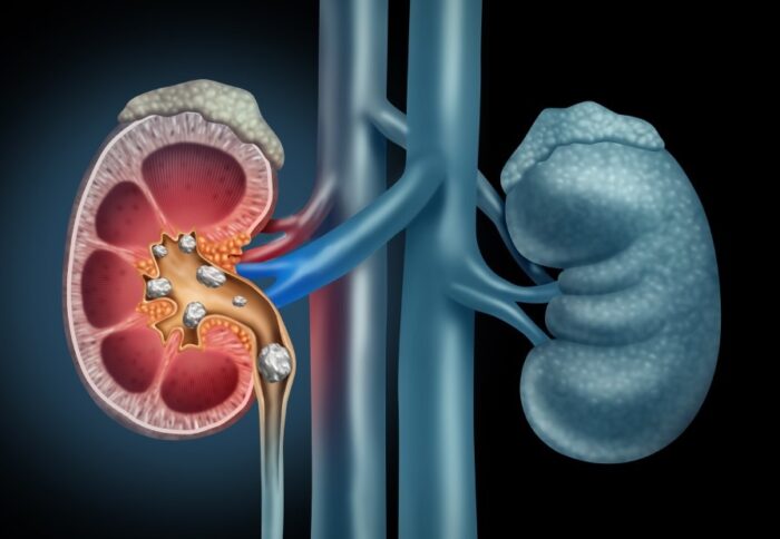 Kidney Stones: కిడ్నీలో రాళ్లను కరిగించే అద్భుతమైన చిట్కాలు..