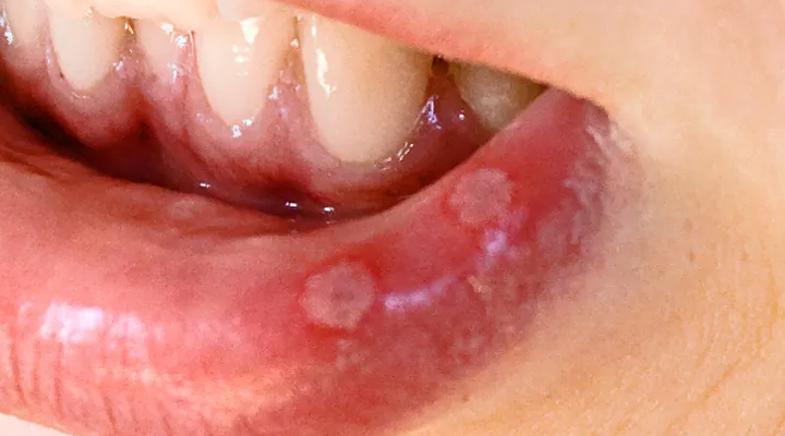 Mouth Ulcer: నోటిలో పుండ్లు వస్తున్నాయా? ఈ చిట్కాలు పాటించండి