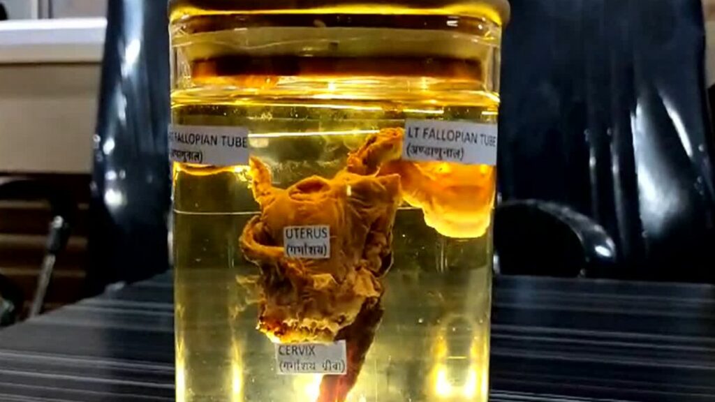 Uterus In Man Stomach