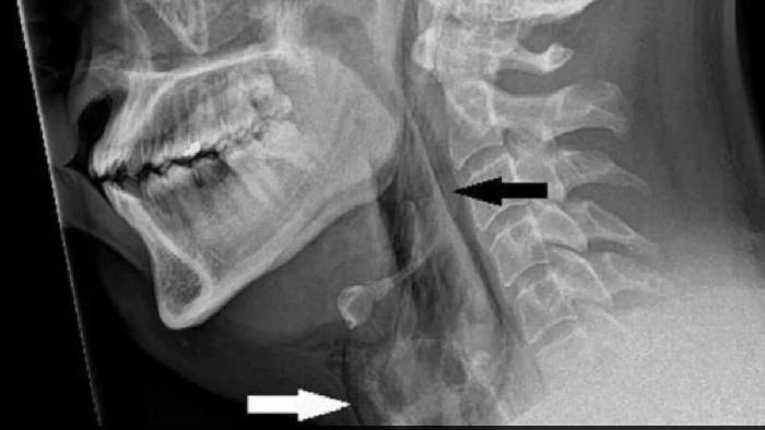 Holding Sneeze: తుమ్మును ఆపుకోవాలని చూస్తే ప్రమాదమే.. ఏకంగా శ్వాసనాళం పగిలిపోయింది..