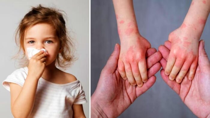 Year End 2023 : 2023 లో వార్తల్లో నిలిచిన భయంకరమైన వ్యాధులు ఇవే..