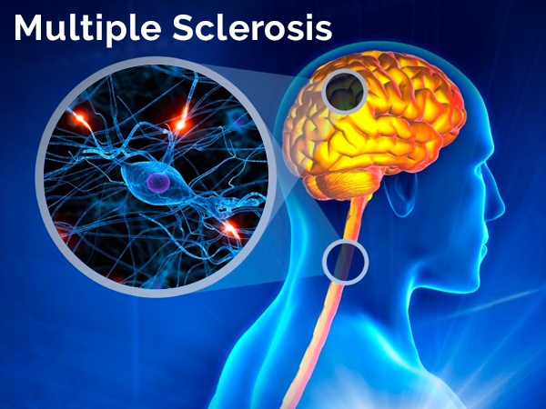 Multiple Sclerosis