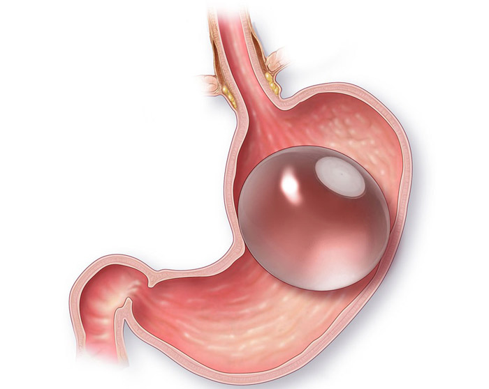 Intragastric Balloon