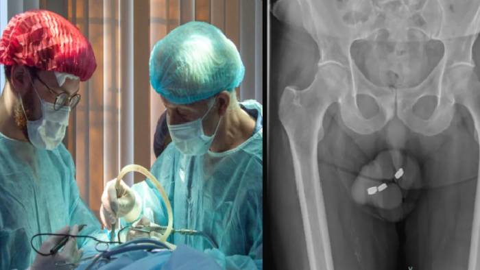 Australia: ప్రైవేట్ పార్ట్‌లోకి బ్యాటరీలు చొప్పించుకున్న వ్యక్తి.. ఆ తర్వాత ఏమైందంటే..?