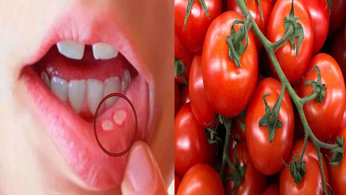 Health Tips: నోటి పుండ్లు వస్తే టొమాటోలతో ఇలా చేయండి.. వెంటనే తగ్గిపోతుంది