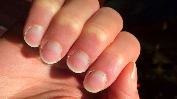 Nail Symptoms: గోళ్లలో ఇలాంటి మార్పులొచ్చాయా.. ‘లివర్ డ్యామేజ్’కు సంకేతమట!